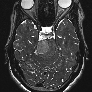 Cerebellopontine angle meningioma (Radiopaedia 72983-83680 Axial FIESTA 51).jpg