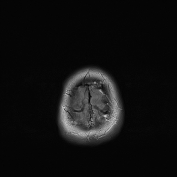 Cerebral abscess (Radiopaedia 24212-24478 Axial T2 55).jpg