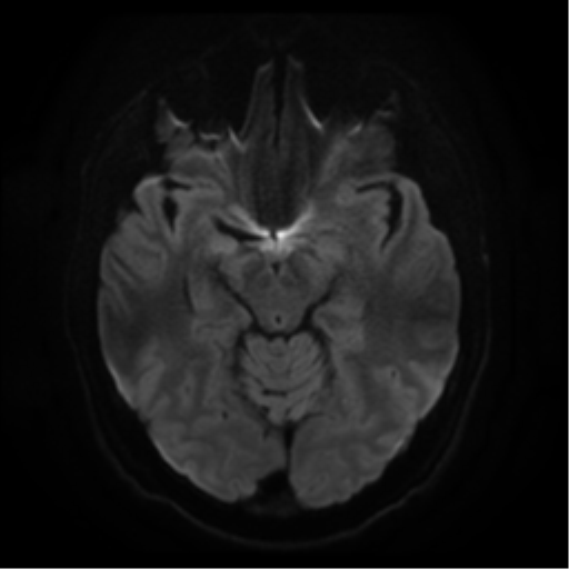 Cerebral abscess (Radiopaedia 57774-64740 Axial DWI 11).png