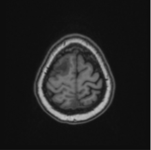 File:Cerebral abscess from pulmonary arteriovenous malformation (Radiopaedia 86275-102291 Axial T1 66).png