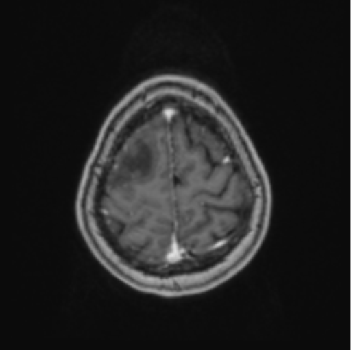 Cerebral abscess from pulmonary arteriovenous malformation (Radiopaedia 86275-102291 Axial T1 C+ 65).png