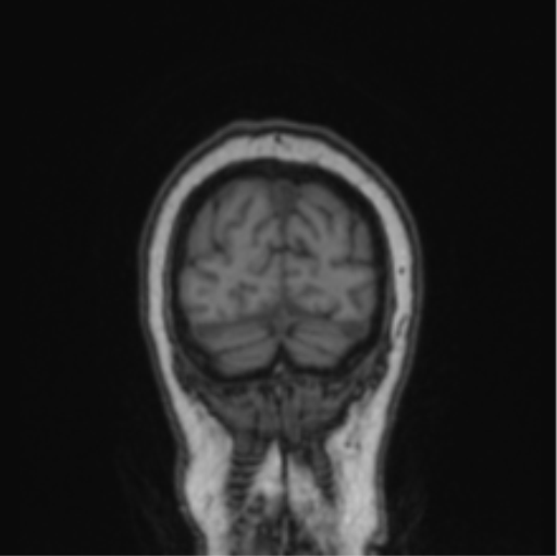 Cerebral abscess from pulmonary arteriovenous malformation (Radiopaedia 86275-102291 Coronal T1 13).png