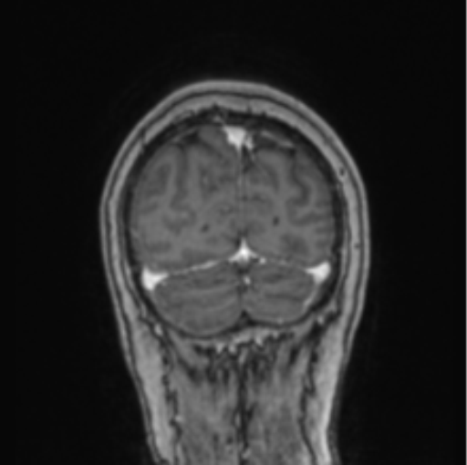File:Cerebral abscess from pulmonary arteriovenous malformation (Radiopaedia 86275-102291 L 17).png