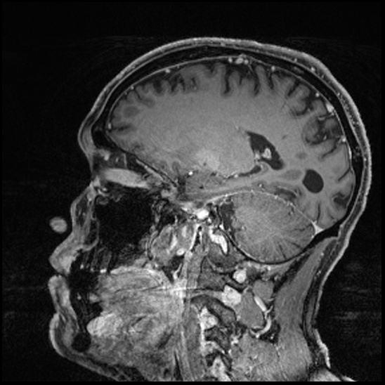 Cerebral abscess with ventriculitis (Radiopaedia 78965-91878 Sagittal T1 C+ 114).jpg