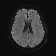 Cerebral amyloid angiopathy-related inflammation (Radiopaedia 74836-85849 Axial DWI 49).jpg