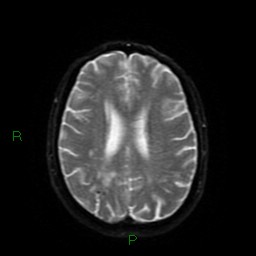 Cerebral amyloid angiopathy (Radiopaedia 77506-89664 Axial DWI 47).jpg