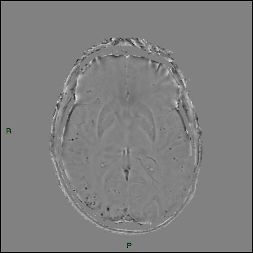 Cerebral amyloid angiopathy (Radiopaedia 77506-89664 H 53).jpg