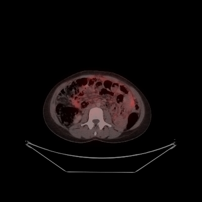 Cerebral and abdominal tuberculosis (Radiopaedia 90499-107853 C 175).jpg