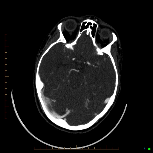 Cerebral arteriovenous malformation (AVM) (Radiopaedia 78162-90706 Axial CTA 110).jpg