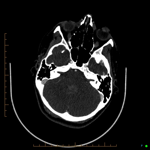 Cerebral arteriovenous malformation (AVM) (Radiopaedia 78162-90706 Axial CTA 84).jpg