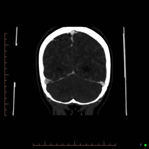 Cerebral arteriovenous malformation (AVM) (Radiopaedia 78162-90706 Coronal CTA 25).jpg