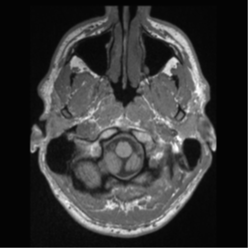 Cerebral arteriovenous malformation (Radiopaedia 55798-62372 Axial T1 1).png