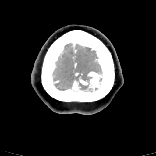 Cerebral arteriovenous malformation (Radiopaedia 73830-84645 B 9).jpg