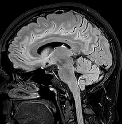 Cerebral arteriovenous malformation (Radiopaedia 74411-85746 Sagittal FLAIR 52).jpg
