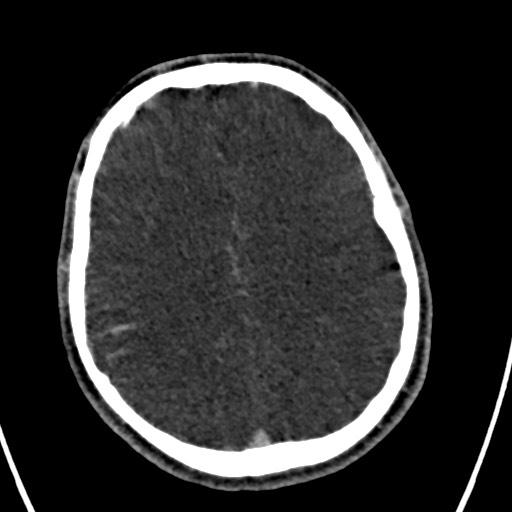 Cerebral arteriovenous malformation (Radiopaedia 78188-90746 Axial C+ delayed 117).jpg