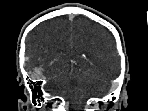Cerebral arteriovenous malformation (Radiopaedia 78188-90746 Coronal C+ delayed 82).jpg