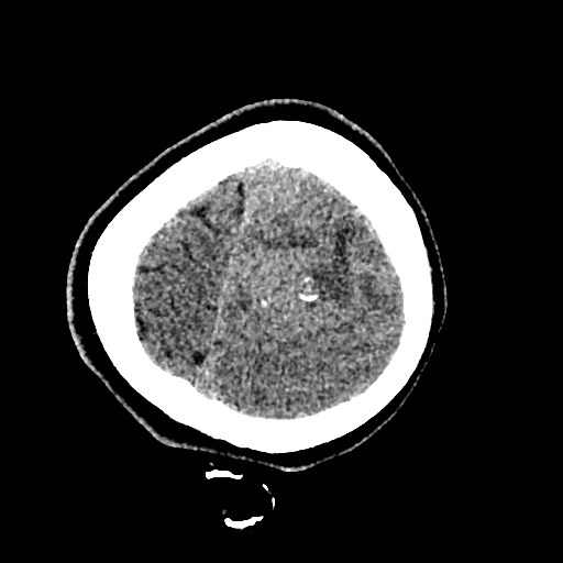 Cerebral arteriovenous malformation (Radiopaedia 79677-92887 Axial non-contrast 55).jpg