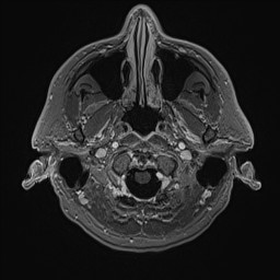 Cerebral arteriovenous malformation (Radiopaedia 84015-99245 Axial T1 C+ 21).jpg