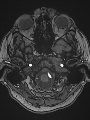 File:Cerebral arteriovenous malformation (Radiopaedia 84015-99245 Axial TOF 58).jpg
