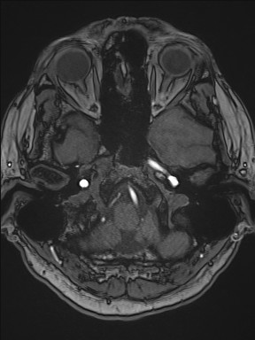 Cerebral arteriovenous malformation (Radiopaedia 84015-99245 Axial TOF 64).jpg