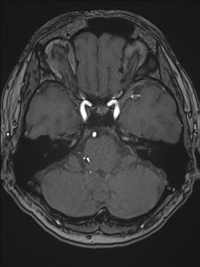 Cerebral arteriovenous malformation (Radiopaedia 84015-99245 Axial TOF 80).jpg