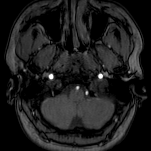 Cerebral arteriovenous malformation at posterior body of corpus callosum (Radiopaedia 74111-84925 Axial MRA 13).jpg