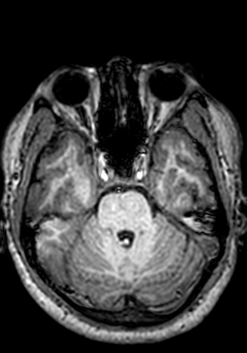 Cerebral arteriovenous malformation at posterior body of corpus callosum (Radiopaedia 74111-84925 Axial T1 219).jpg