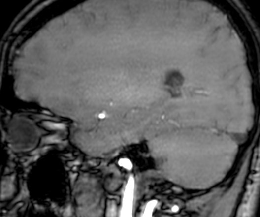 Cerebral arteriovenous malformation at posterior body of corpus callosum (Radiopaedia 74111-84925 J 273).jpg