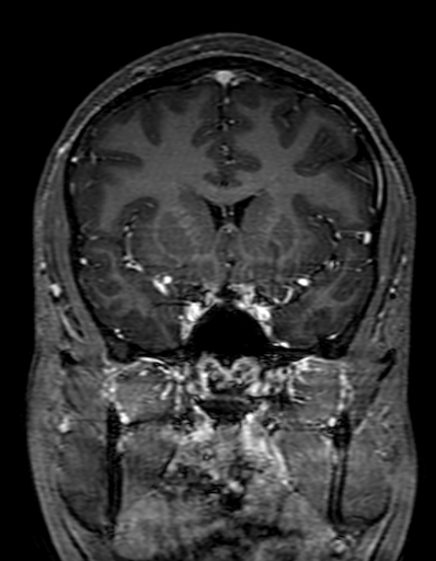 Cerebral arteriovenous malformation at posterior body of corpus callosum (Radiopaedia 74111-84925 K 133).jpg