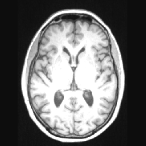 Cerebral arteriovenous malformation with hemorrhage (Radiopaedia 34422-35737 Axial T1 40).png