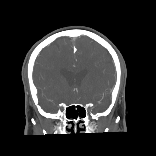 Cerebral arteriovenous malformation with lobar hemorrhage (Radiopaedia 35598-57216 C 34).jpg
