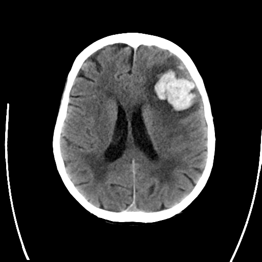File:Cerebral arteriovenous malformation with lobar hemorrhage (Radiopaedia 44725-48512 Axial non-contrast 22).png