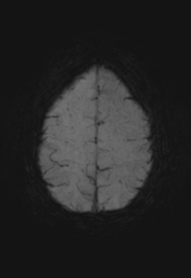 File:Cerebral cavernoma and development venous anomaly (Radiopaedia 37603-39482 Axial SWI MIP 27).png