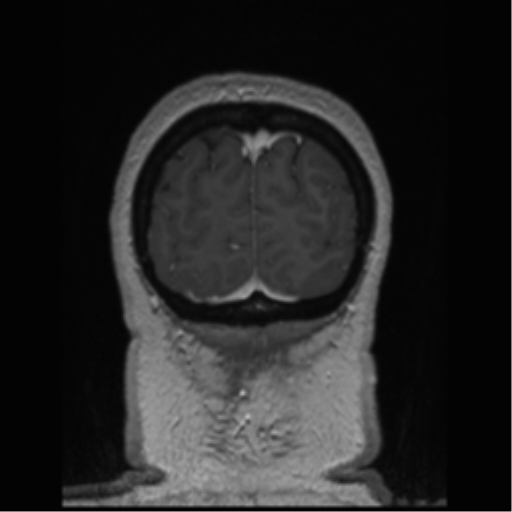Cerebral cavernoma and development venous anomaly (Radiopaedia 37603-39482 Coronal T1 C+ 11).png