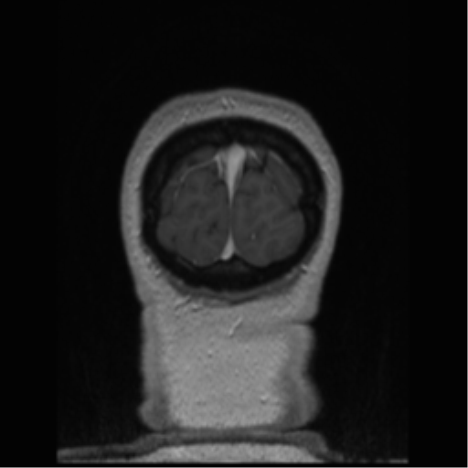 Cerebral cavernoma and development venous anomaly (Radiopaedia 37603-39482 Coronal T1 C+ 7).png