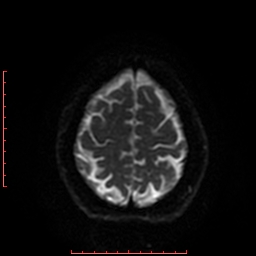 File:Cerebral cavernous malformation (Radiopaedia 26177-26306 Axial DWI 38).jpg