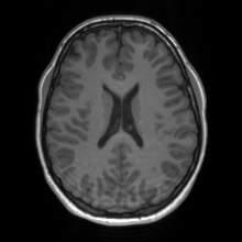 Cerebral cavernous venous malformation (Radiopaedia 70008-80021 Axial T1 47).jpg