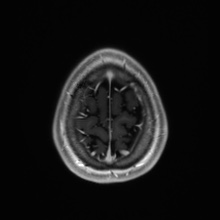 Cerebral cavernous venous malformation (Radiopaedia 70008-80021 Axial T1 C+ 93).jpg