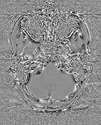 Cerebral cavernous venous malformation (Radiopaedia 70008-80021 G 9).jpg