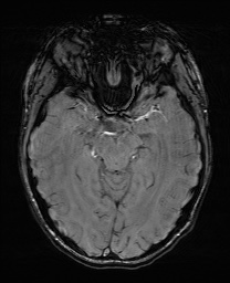 Cerebral cavernous venous malformation (Radiopaedia 70008-80021 I 29).jpg