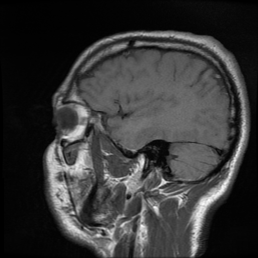 File:Cerebral cavernous venous malformation (Zabramski type II) (Radiopaedia 85511-101198 Sagittal T1 10).jpg
