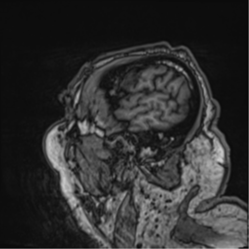 Cerebral embolic infarcts (embolic shower) (Radiopaedia 57395-64342 Sagittal T1 17).png