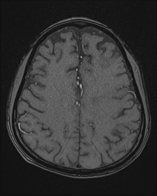 Cerebral embolic infarcts (embolic shower) (Radiopaedia 72391-82921 Axial MRA 143).jpg