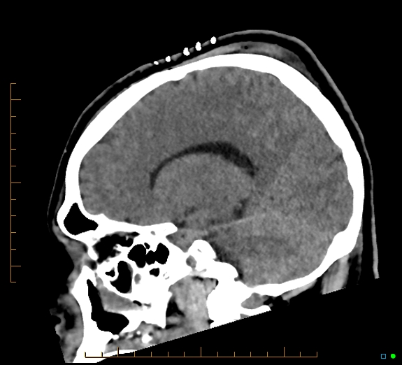 Cerebral fat embolism (Radiopaedia 85521-101224 C 31).jpg