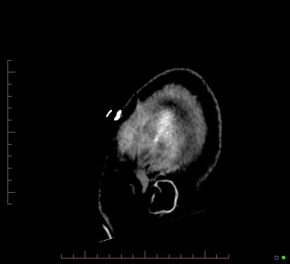 Cerebral fat embolism (Radiopaedia 85521-101224 C 52).jpg