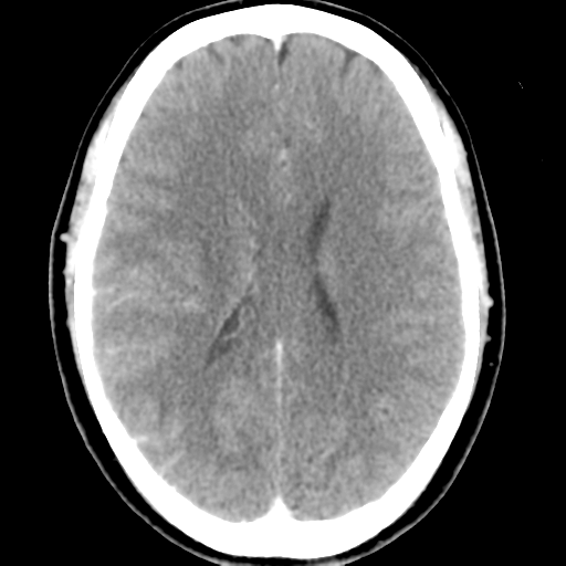 Cerebral hemorrhage secondary to arteriovenous malformation (Radiopaedia 33497-34561 B 33).png