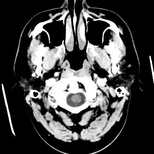 File:Cerebral hemorrhage secondary to arteriovenous malformation (Radiopaedia 33497-34561 B 4).png