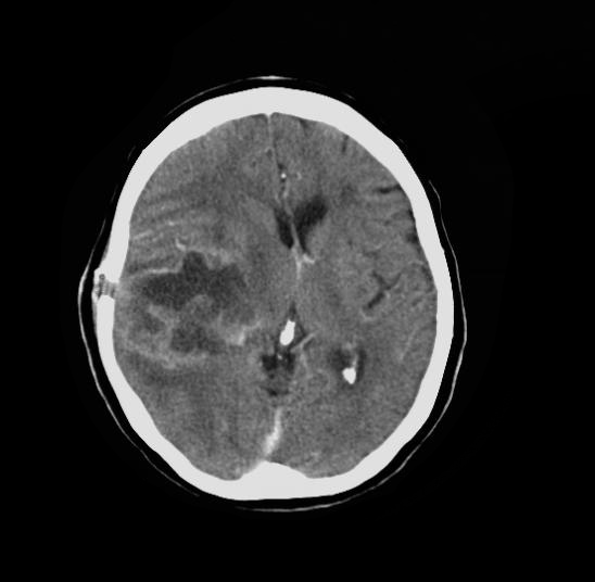 File:Cerebral infarction vs glioblastoma (Radiopaedia 10136-10676 Axial C+ 1).jpeg