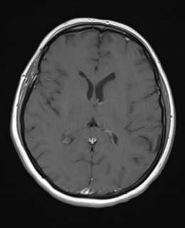 File:Cerebral metastases mimicking abscesses (Radiopaedia 45841-50131 Axial T1 C+ fat sat 16).png