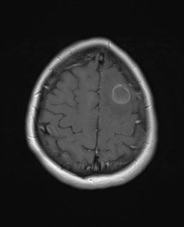 File:Cerebral metastases mimicking abscesses (Radiopaedia 45841-50131 Axial T1 C+ fat sat 24).png